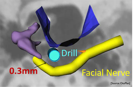 Advanced Medical Image Analysis of the Human Facial Nerve Based on Machine Learning Technologies