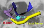 Advanced Medical Image Analysis of the Human Facial Nerve Based on Machine Learning Technologies